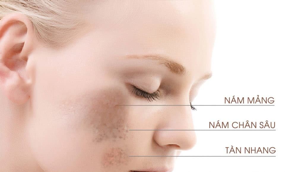 Hình ảnh nám sạm